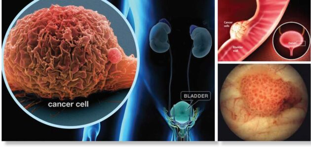 Bladder Cancer Treatment | Dr. Subodh Kamble Surat